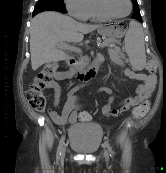 File:Acute renal failure post IV contrast injection- CT findings (Radiopaedia 47815-52557 Coronal non-contrast 18).jpg