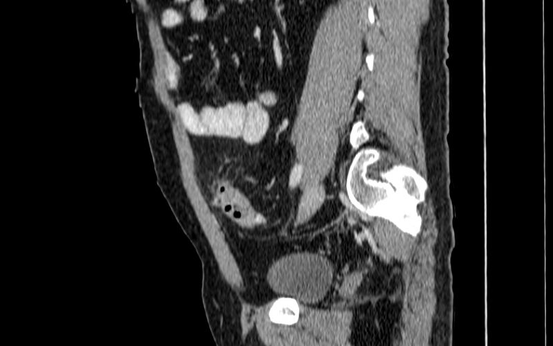 File:Acute sigmoid colon diverticulitis (Radiopaedia 55507-61976 Sagittal C+ portal venous phase 44).jpg