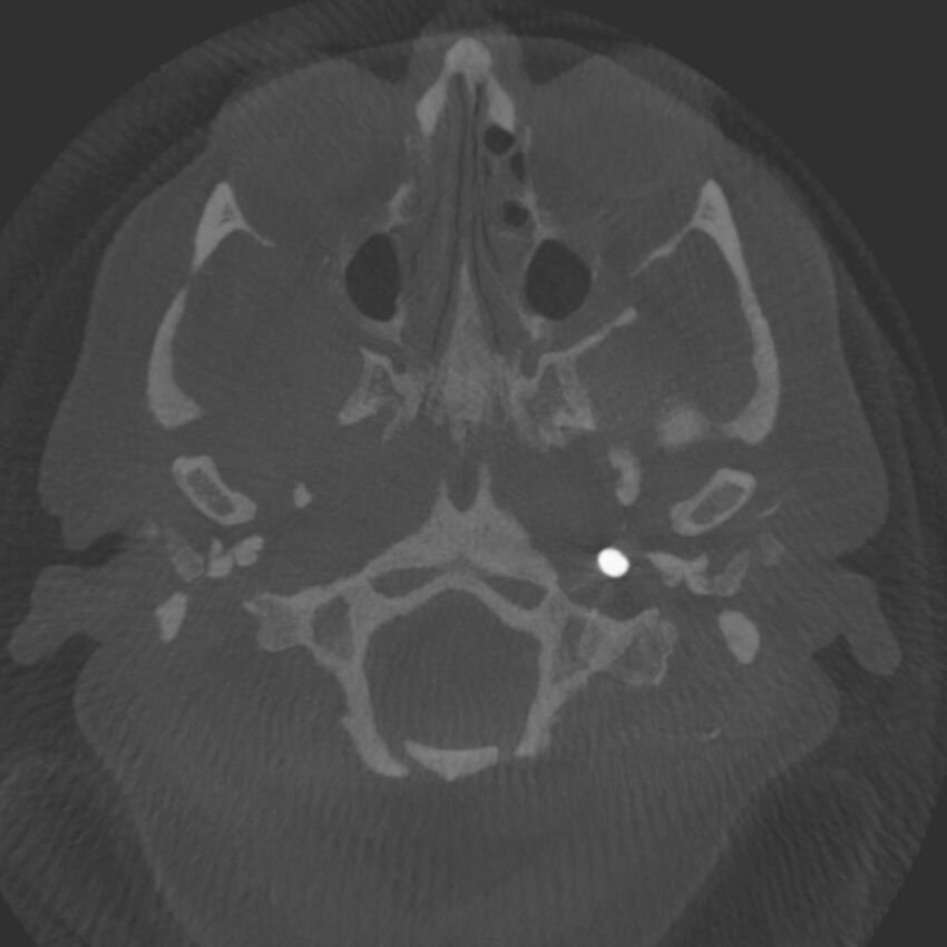 Acute subarachnoid hemorrhage and accessory anterior cerebral artery (Radiopaedia 69231-79010 C 2).jpg