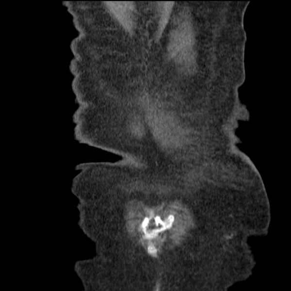 File:Acute tubular necrosis (Radiopaedia 28077-28334 D 78).jpg