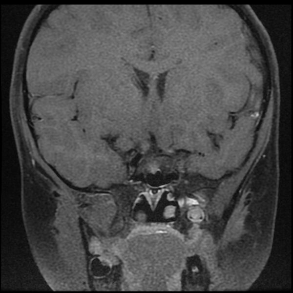 File:Adamantinomatous craniopharyngioma (Radiopaedia 77407-89529 Coronal T1 C+ fat sat 3).jpg