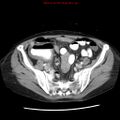 Adenocarcinoma of the colon (Radiopaedia 8191-9039 Axial liver window 57).jpg