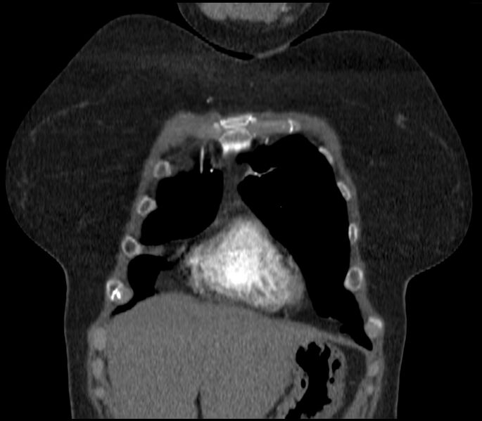File:Adenocarcinoma of the lung (Radiopaedia 44205-47803 Coronal C+ portal venous phase 14).jpg