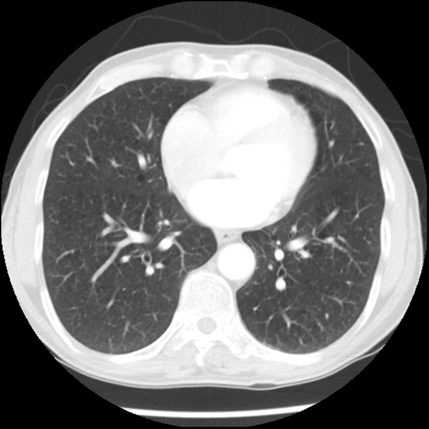 Adenocarcinoma of the lung - micropapillary predominant (Radiopaedia 42446-45563 Axial lung window 48).jpg