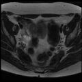Adenoma malignum of the cervix (Radiopaedia 24460-24765 C 5).jpg