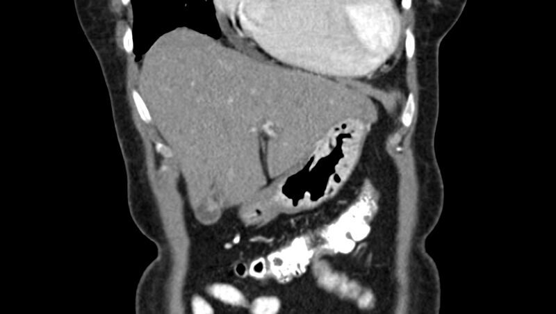 File:Adenomyomatosis of the gallbladder (Radiopaedia 12142-12483 Coronal C+ arterial phase 5).jpg