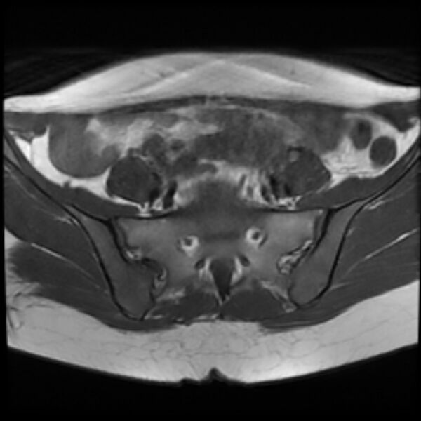 File:Adenomyosis within a septate uterus (Radiopaedia 69963-79981 Axial T1 8).jpg