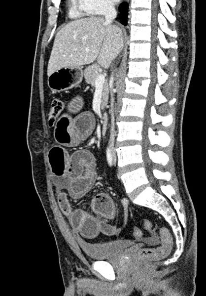 File:Adhesional small bowel obstruction (Radiopaedia 58900-66131 Sagittal C+ portal venous phase 121).jpg