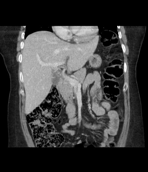 File:Adrenal cortical carcinoma with IVC invasion and thrombosis (Radiopaedia 34307-35597 Coronal C+ portal venous phase 22).jpg