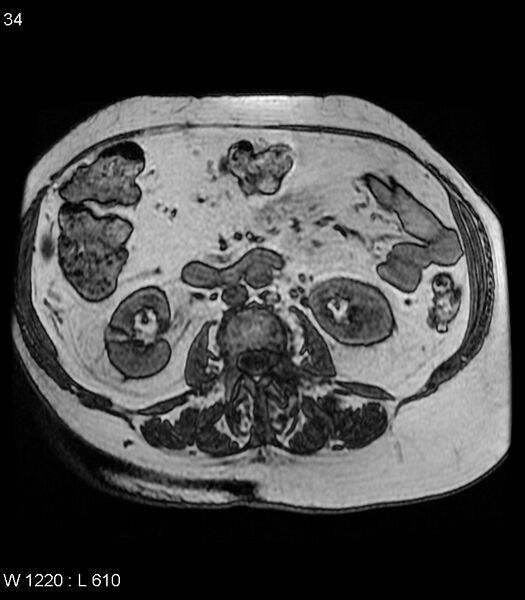 File:Adrenal myelolipoma (Radiopaedia 6765-7961 Axial T1 out-of-phase 34).jpg