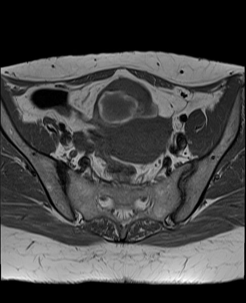 File:Adult granulosa cell tumor of the ovary (Radiopaedia 71581-81950 Axial T1 11).jpg