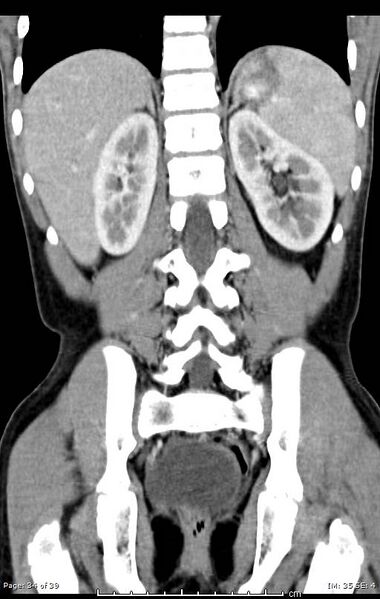 File:Agenesis of the gallbladder (Radiopaedia 55454-61905 A 34).jpg