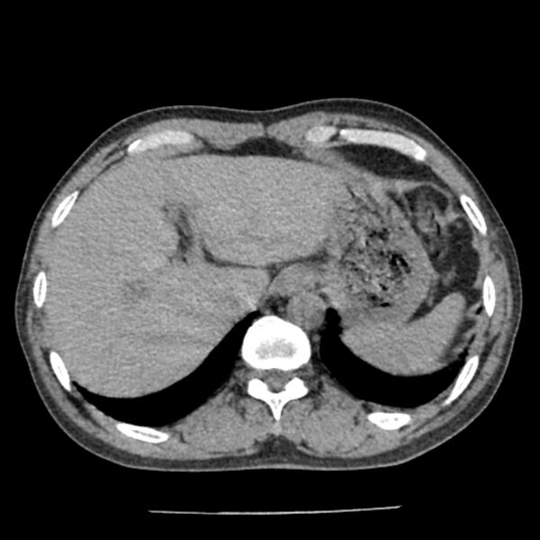 File:Airway foreign body in adult (Radiopaedia 85907-101779 Axial liver window 186).jpg