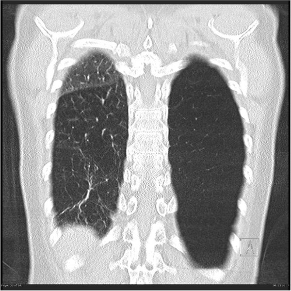 File:Alpha-1-antitrypsin deficiency (Radiopaedia 26537-26678 Coronal lung window 30).jpg