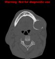 Ameloblastoma (Radiopaedia 13276-13280 Axial non-contrast 7).jpg