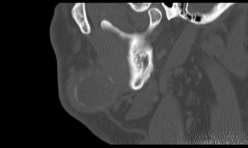 File:Ameloblastoma (Radiopaedia 33677-34806 Sagittal bone window 17).png