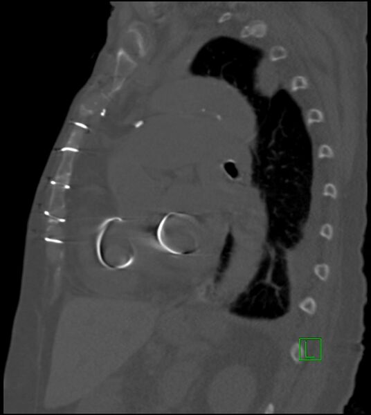 File:Amiodarone deposition in the liver (Radiopaedia 77587-89780 Sagittal bone window 42).jpg