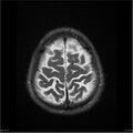Amnestic syndrome secondary to hypoxic brain injury (Radiopaedia 24743-25004 T2 19).jpg