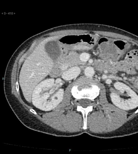 File:Ampulla of Vater metastasis (Radiopaedia 27820-28065 A 14).jpg