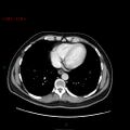 Ampullary carcinoma (Radiopaedia 56396-63056 C 6).jpg