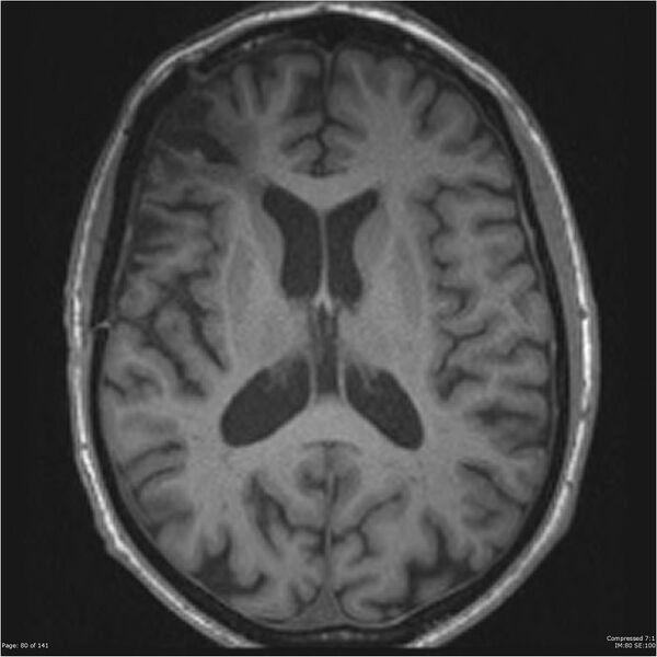 File:Anaplastic meningioma with recurrence (Radiopaedia 34452-35788 Axial T1 78).jpg