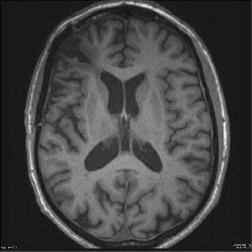 Anaplastic meningioma with recurrence (Radiopaedia 34452-35788 Axial T1 78).jpg