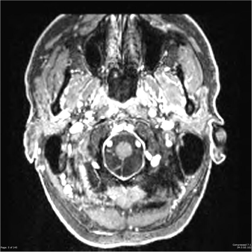 Anaplastic meningioma with recurrence (Radiopaedia 34452-35788 Axial T1 C+ 5).jpg