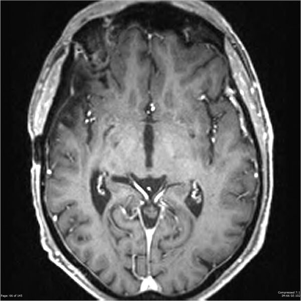 File:Anaplastic meningioma with recurrence (Radiopaedia 34452-35788 Axial T1 C+ 66).jpg