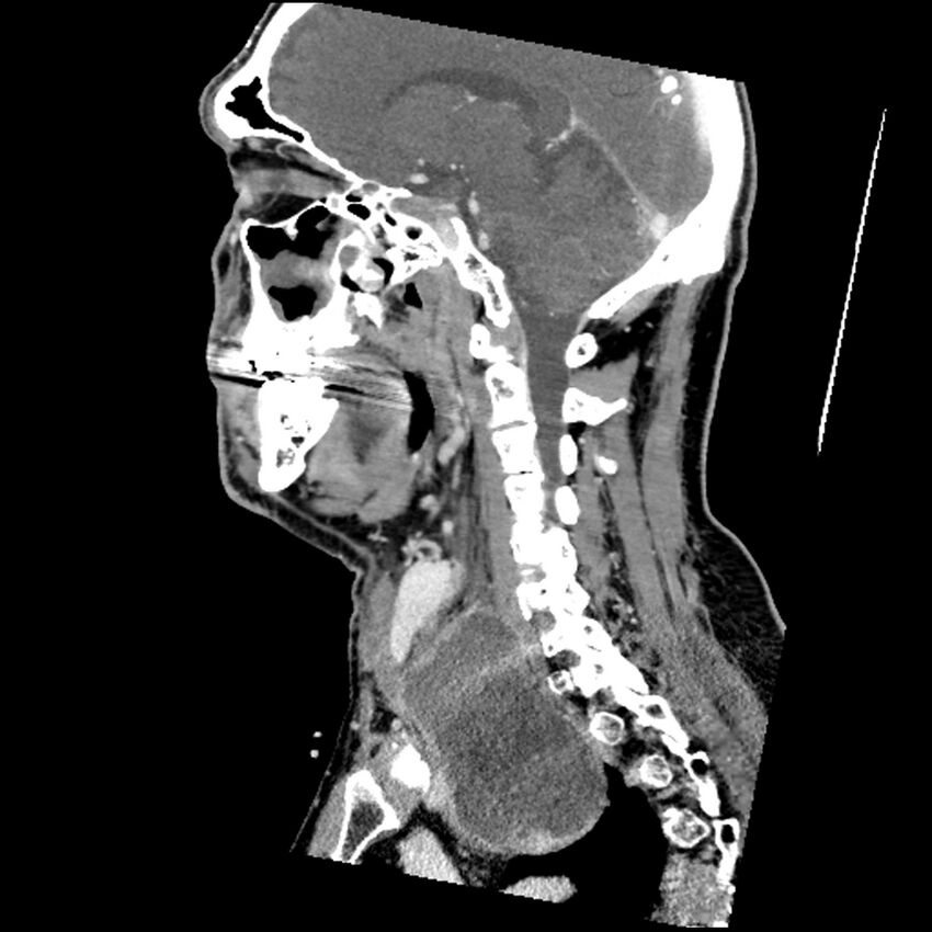 Anaplastic thyroid carcinoma (Radiopaedia 79087-92034 C 40).jpg