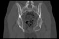 Aneurysmal bone cyst of ischium (Radiopaedia 25957-26094 Coronal bone window 28).png