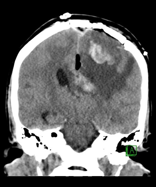 File:Angiomatous meningioma (Radiopaedia 79459-92578 Coronal non-contrast 21).jpg