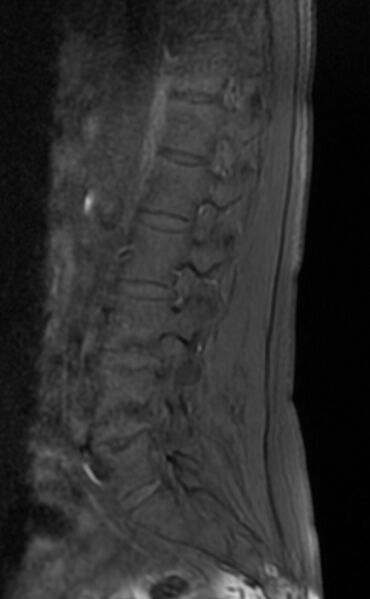 File:Ankylosing spondylitis - Andersson lesion (Radiopaedia 81878-95838 Sagittal T1 fat sat 9).jpg