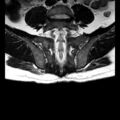 Ankylosing spondylitis with zygapophyseal arthritis (Radiopaedia 38433-40517 C 11).jpg