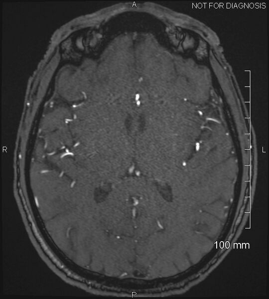 File:Anterior cerebral artery aneurysm (Radiopaedia 80683-94127 Axial MRA 134).jpg