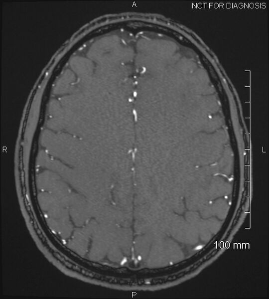 File:Anterior cerebral artery aneurysm (Radiopaedia 80683-94127 Axial MRA 175).jpg