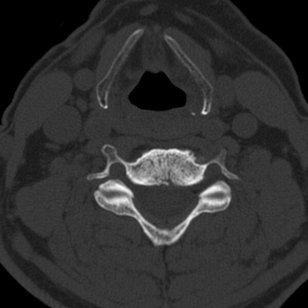 File:Anterior cervical postdiscectomy arthrodesis (Radiopaedia 32678-33646 Axial bone window 44).jpg