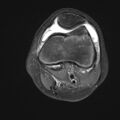 Anterior cruciate ligament tear - pediatric (Radiopaedia 62152-70260 Axial PD fat sat 12).jpg