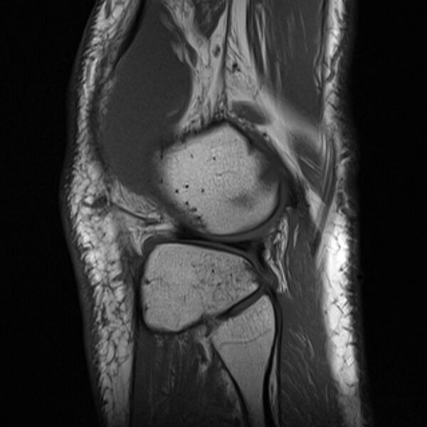 File:Anterior cruciate ligament tear - ramp lesion (Radiopaedia 71883-82322 Sagittal T1 5).jpg