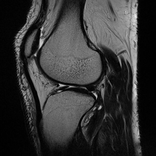 File:Anterior cruciate ligament tear - ramp lesion (Radiopaedia 71883-82322 Sagittal T2 9).jpg