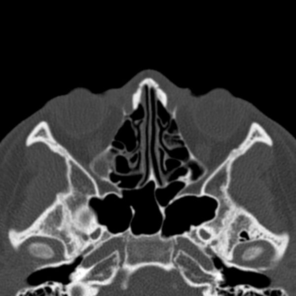 File:Antrochoanal polyp (Radiopaedia 33984-35202 Axial bone window 43).jpg