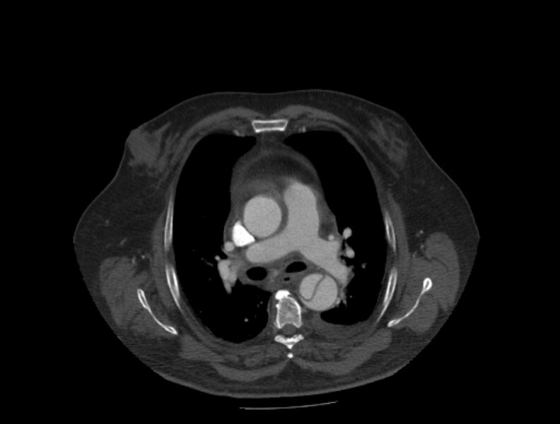 File:Aortic dissection (Radiopaedia 28802-29105 A 15).jpg