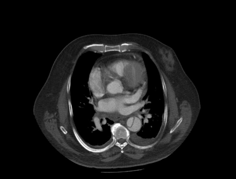 File:Aortic dissection (Radiopaedia 28802-29105 A 21).jpg