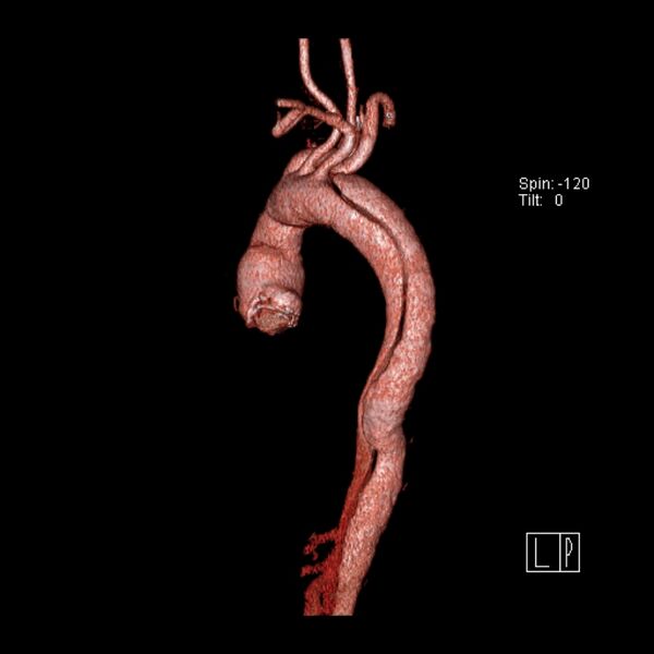File:Aortic dissection - De Bakey type III - Stanford B (Radiopaedia 21903-21882 3D C+ arterial phase 13).jpg