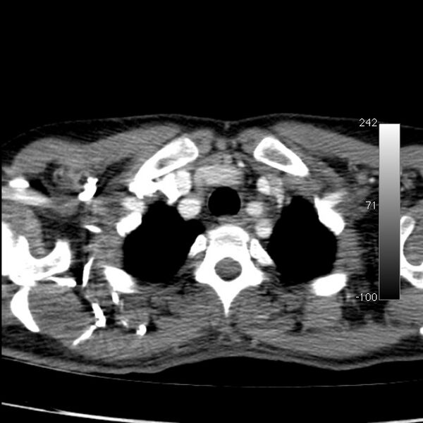 File:Aortic dissection - Stanford type A (Radiopaedia 29247-29659 A 11).jpg