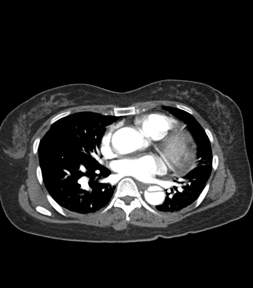 Aortic dissection with renal ischemia (Radiopaedia 76573-88338 A 38).jpg