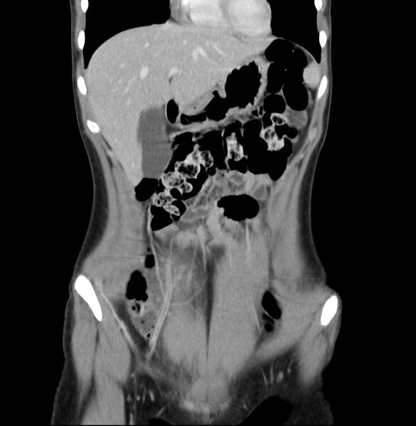 File:Appendicitis and incidental bicornuate uterus (Radiopaedia 22833-22853 D 9).jpg
