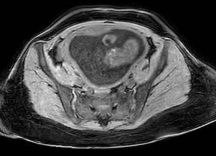 Appendicitis in gravida (MRI) (Radiopaedia 89433-106395 Axial DIXON 114).jpg