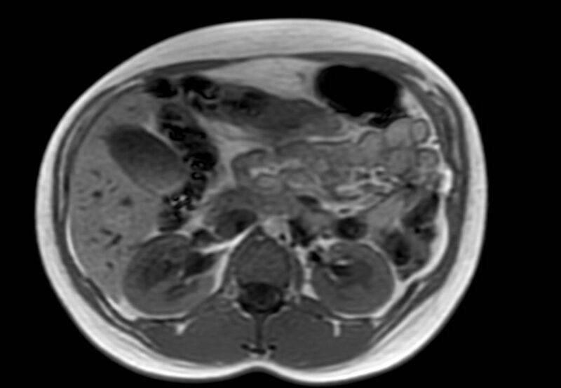 File:Appendicitis in gravida (MRI) (Radiopaedia 89433-106395 Axial T1 in-phase 23).jpg