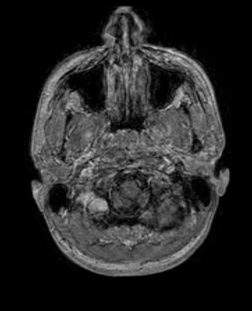 Arachnoid cyst- extremely large (Radiopaedia 68741-78451 Axial T1 C+ 11).jpg