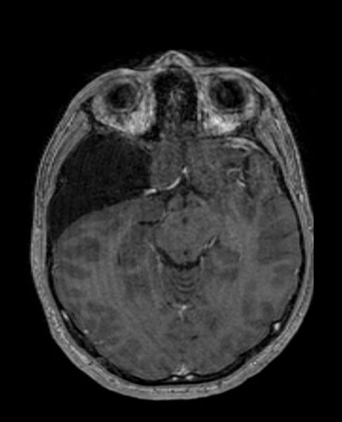 File:Arachnoid cyst- extremely large (Radiopaedia 68741-78451 Axial T1 C+ 35).jpg